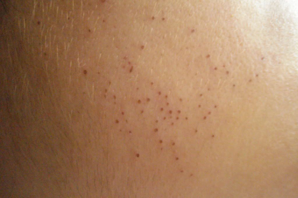 pinprick-red-dots-on-skin-baby